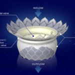This is a HighLife diagram showing important features of its transcatheter mitral valve replacement (TMVR) system.
