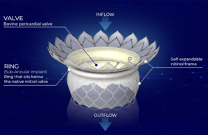This is a HighLife diagram showing important features of its transcatheter mitral valve replacement (TMVR) system.