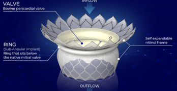 This is a HighLife diagram showing important features of its transcatheter mitral valve replacement (TMVR) system.