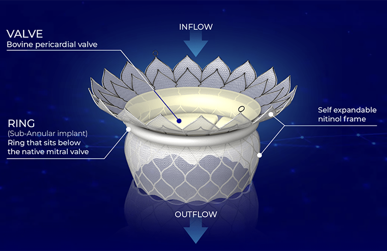 This is a HighLife diagram showing important features of its transcatheter mitral valve replacement (TMVR) system.