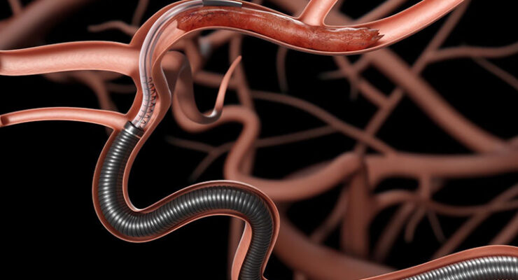 Perfuze’s super-bore stroke catheter tops conventional, cyclic aspiration in bench study