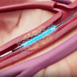 Cordis' Selution SLR drug-eluting balloon illustrated during a percutaneous coronary intervention procedure