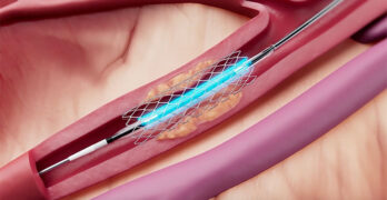 Cordis' Selution SLR drug-eluting balloon illustrated during a percutaneous coronary intervention procedure