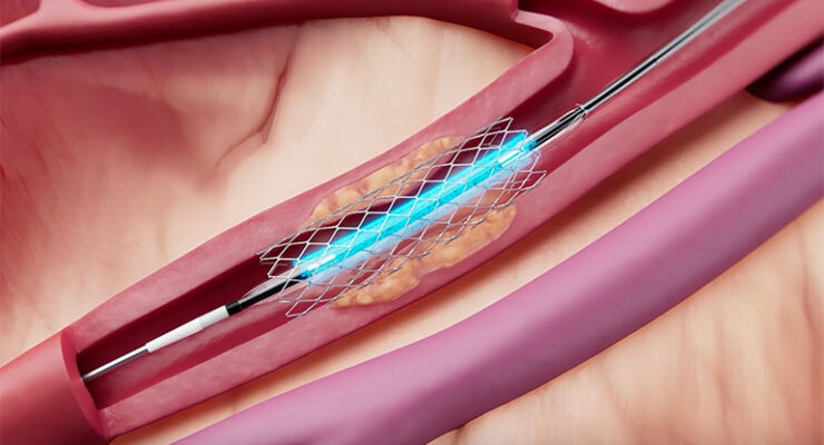 Cordis earns FDA nod for Selution SLR drug-eluting balloon