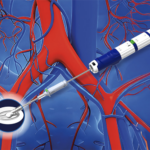 This is a Haemonetics image of the PerQseal Elite vascular closure system.